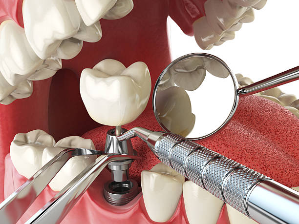 Best Emergency Denture Repair in American Fork, UT